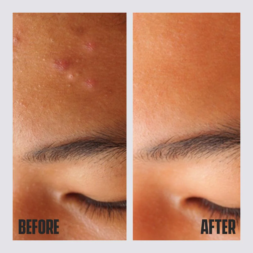 Acne Spot Gel - Image 4