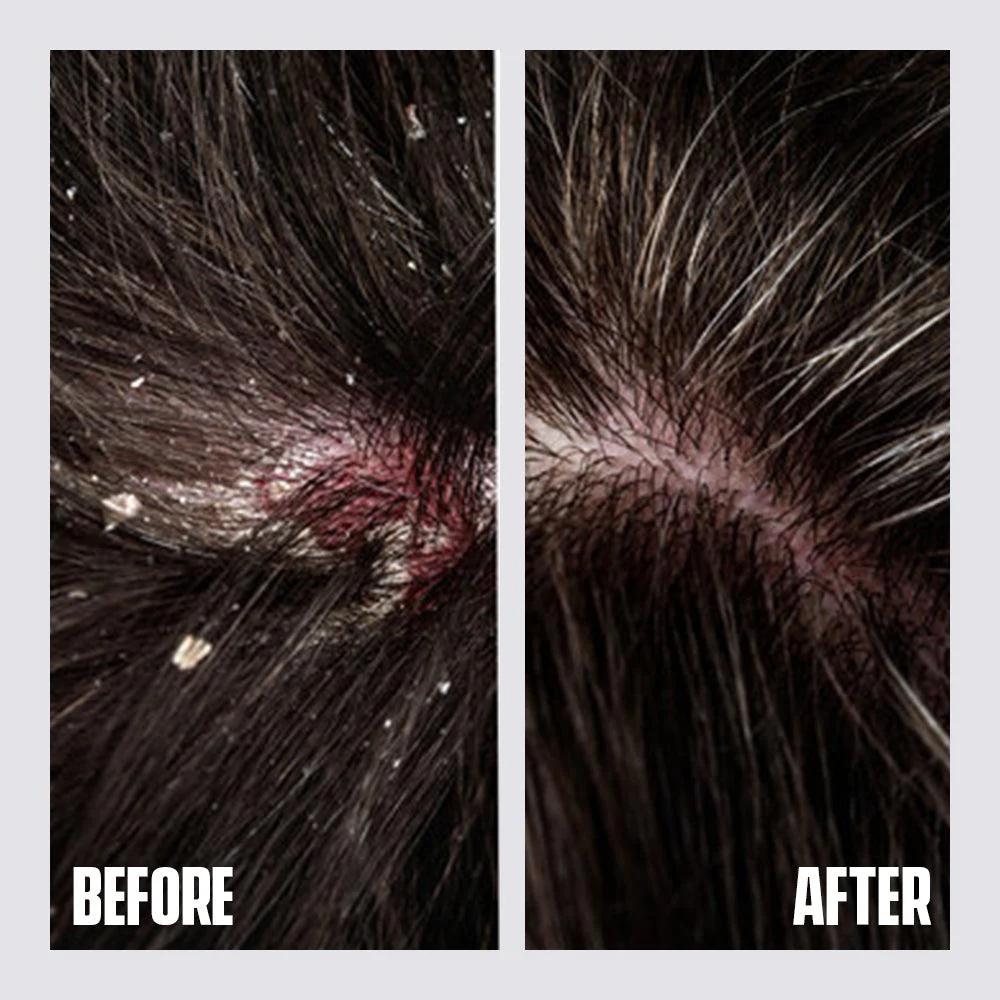 Anti-Dandruff Shampoo – Clear Scalp & Healthy Hair - Image 5